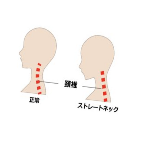 ストレートネック